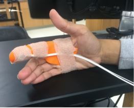 The final prototype of our splint design with the laser Doppler and splint held in place by Coban.