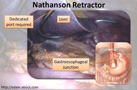 The Nathanson Liver Retractor is the current standard for liver retraction in Nissen Fundoplication.  It cannot be used for SILS procedures since it requires a dedicated port.