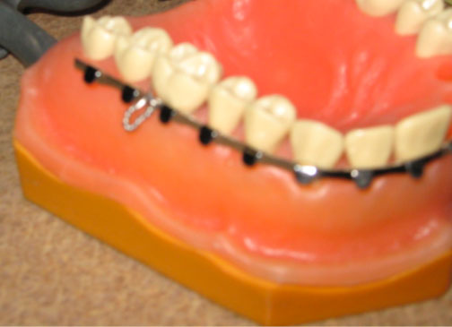 This is the current archbar attached to the teeth by a 24 gauge stainless steel wire.