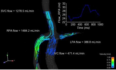 In vitro 4D flow results